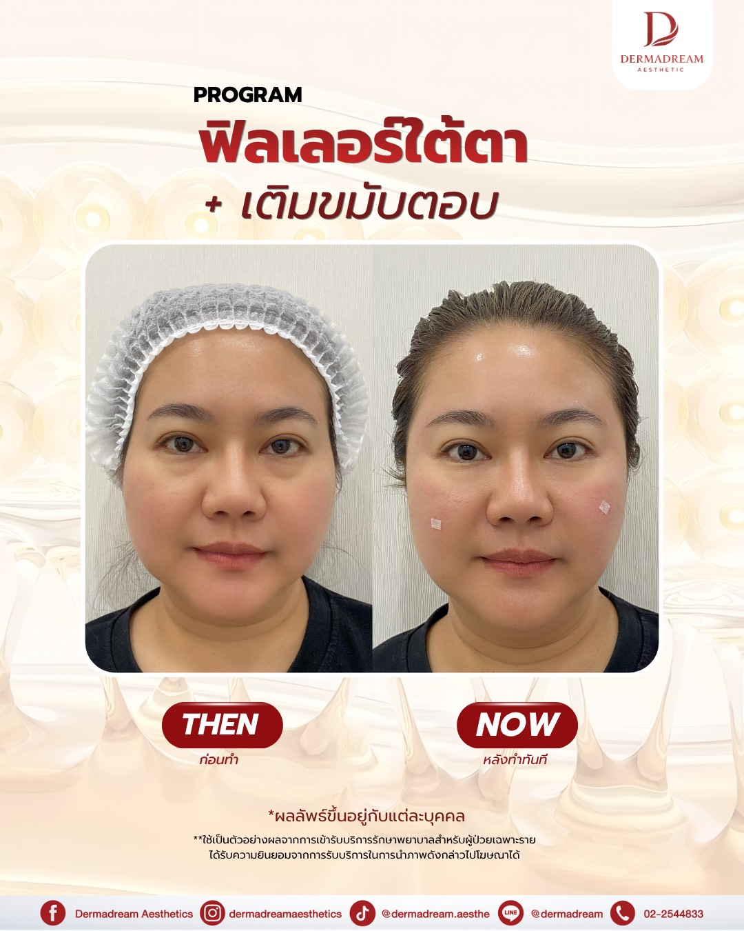 รีวิวฟิลเลอร์ใต้ตาและขมับ