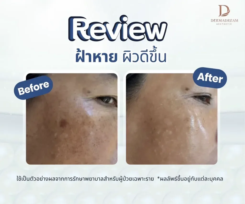 รีวิวการดูแลฝ้าจากคลินิก