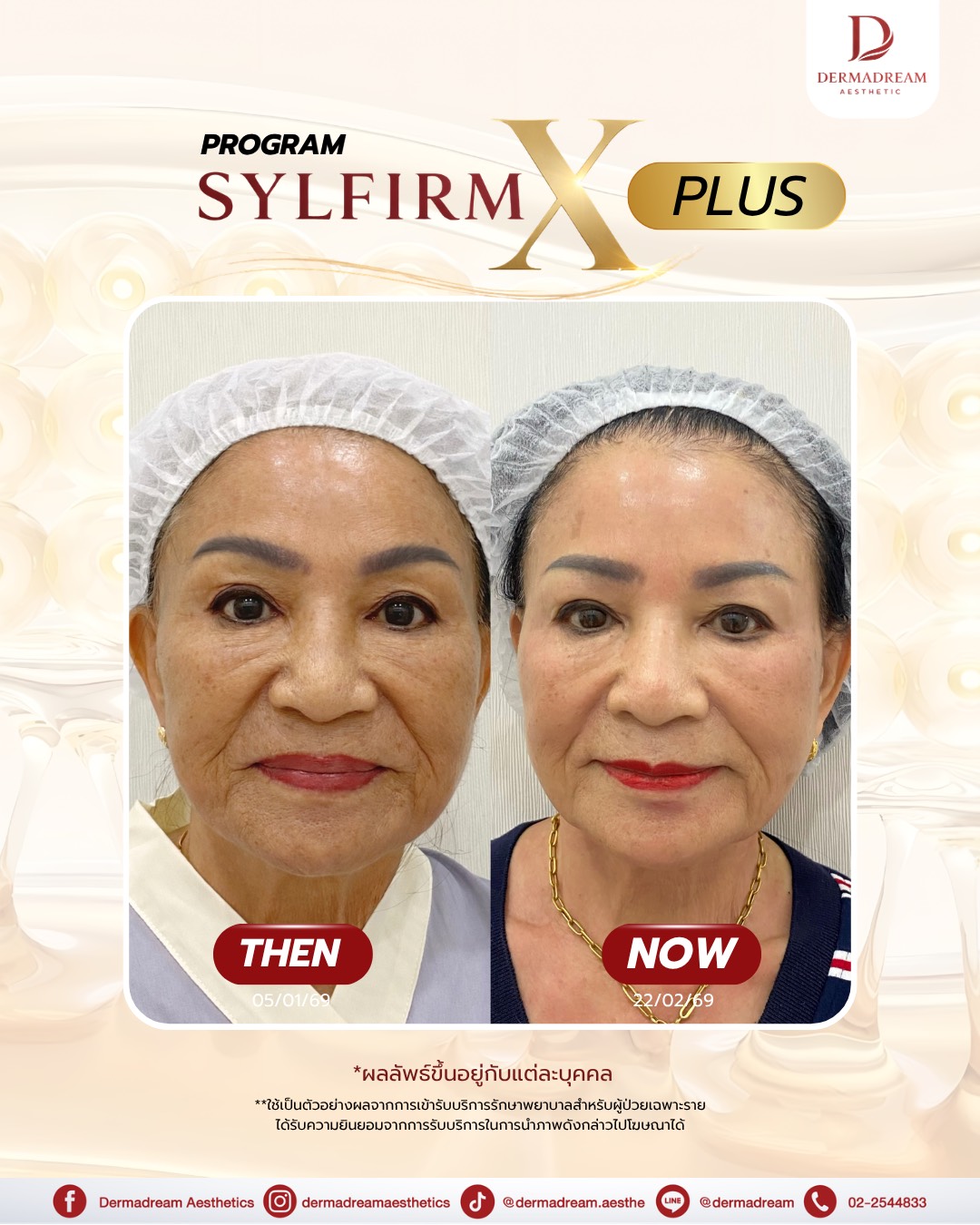 รีวิว Sylfirm X Plus: ภาพมุมหน้าตรง