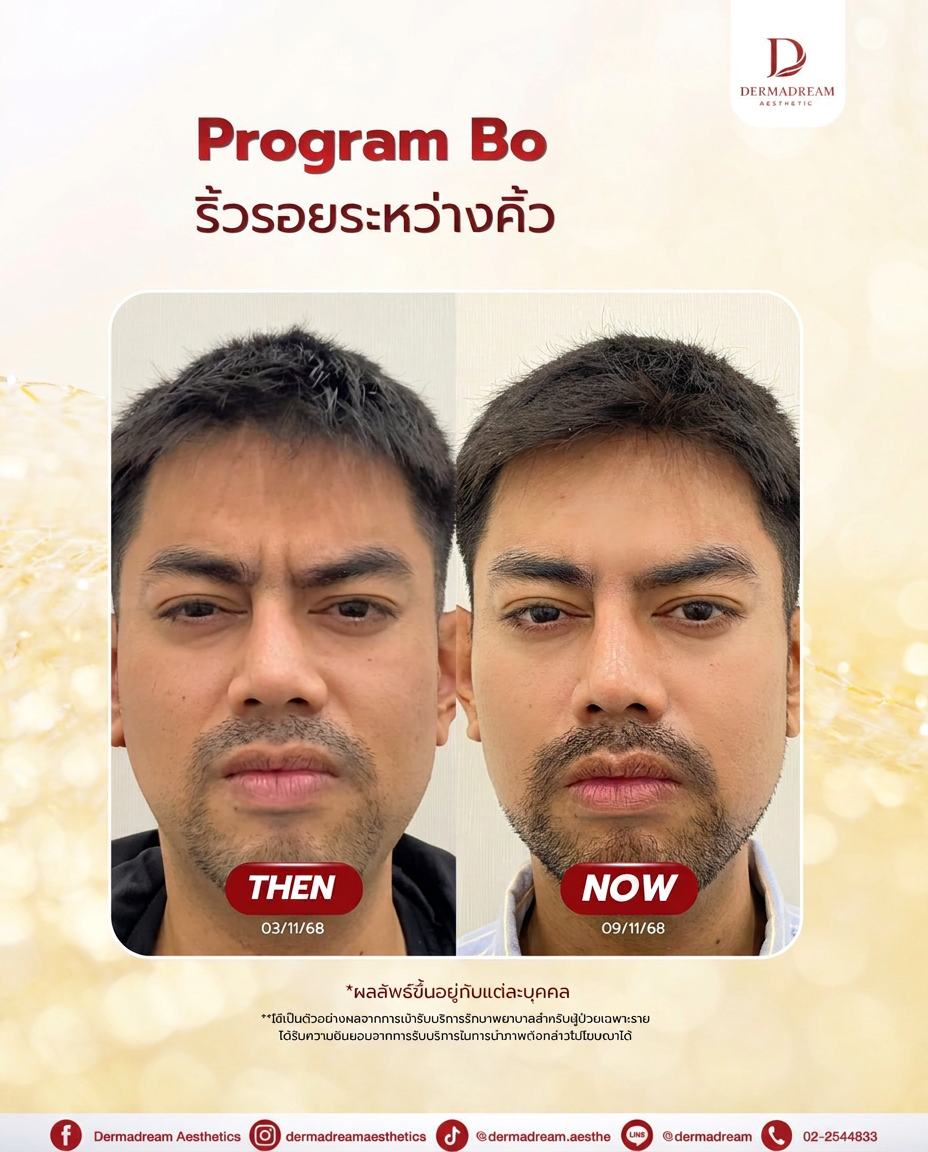 รีวิวการดูแลริ้วรอยระหว่างคิ้ว
